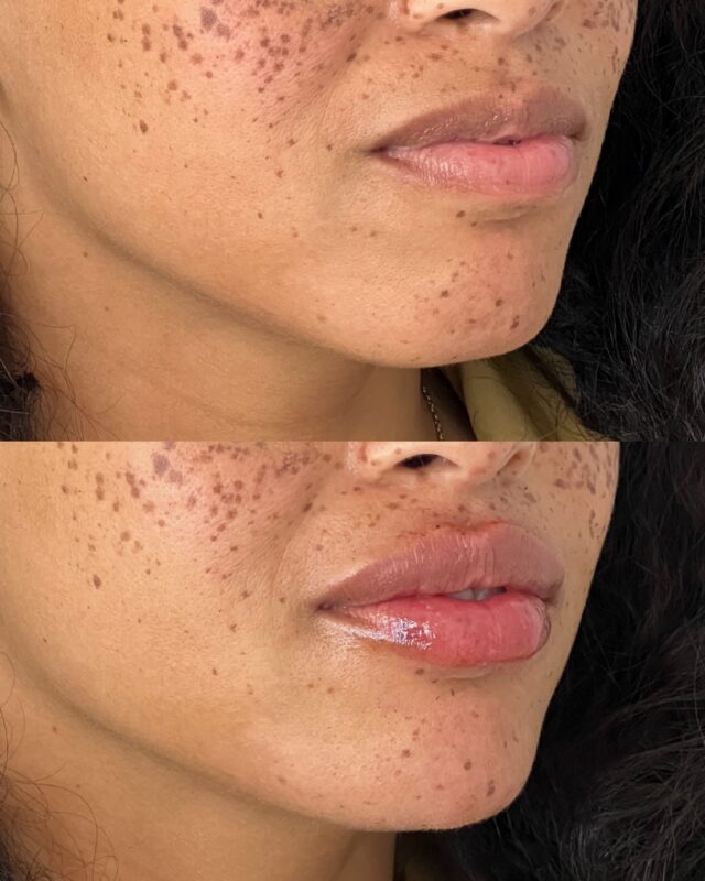 Undetectable, natural results. 

A close look at how our lip filler technique can add volume to a soft, refined look without changing your lip shape. 

Reserve your appointment today at Ecobel Med Spa 
Atlanta, GA | 404-960-0812