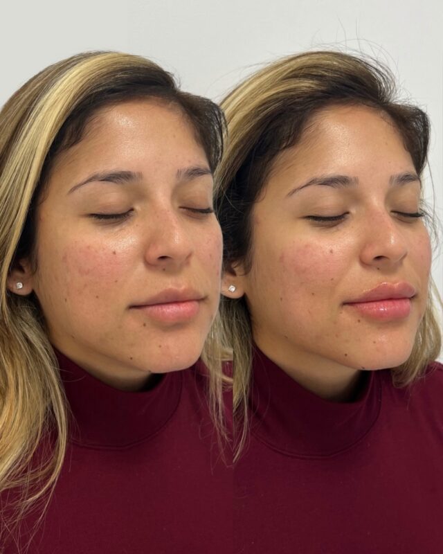 Our approach to injectables starts with what’s already there refining structure, symmetry and balance, rather than changing it. Lip treatments are available at an exclusive rate this month.

Use the link in bio to book or call 404-960-0812