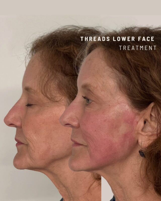 Threads are the treatment for a subtle refresh.

Designed to provide gentle support and encourage collagen production over time, creating natural-looking definition through the lower face, without changing what makes you, you.

Results are gradual, refined, and tailored to your features.
