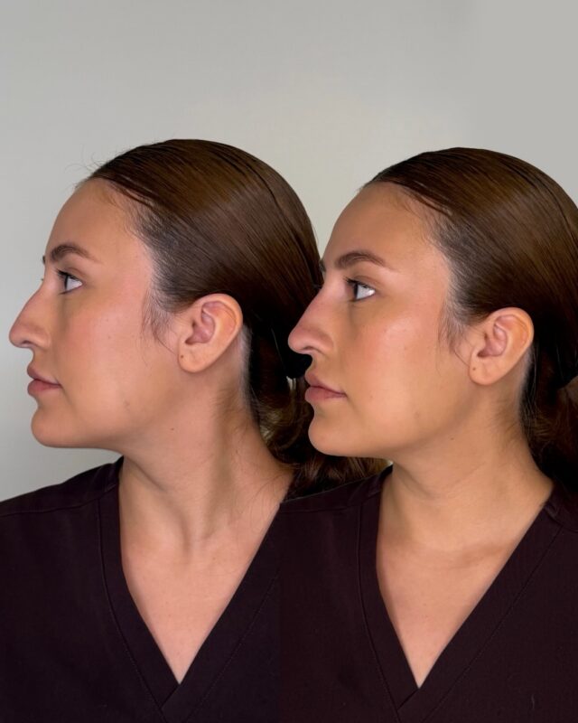 A subtle shift in profile, no surgery required. Our non-surgical rhinoplasty uses precision filler to smooth bumps, refine the tip, and bring balance to the bridge.

Subtle, natural results with no downtime. A small change that balances the side profile and lifts the appearance of the face.