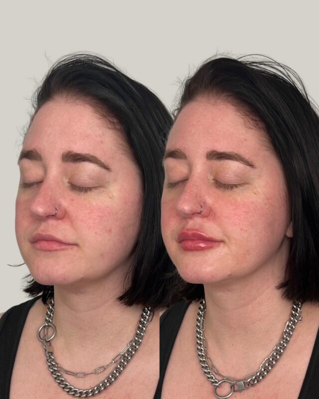 Our favorite kind of treatment.

The kind that enhances, never changes. Subtle volume, added balance, and results that complement your natural features.

Ecobel Med Spa & Plastic Surgery
Located in Atlanta, GA