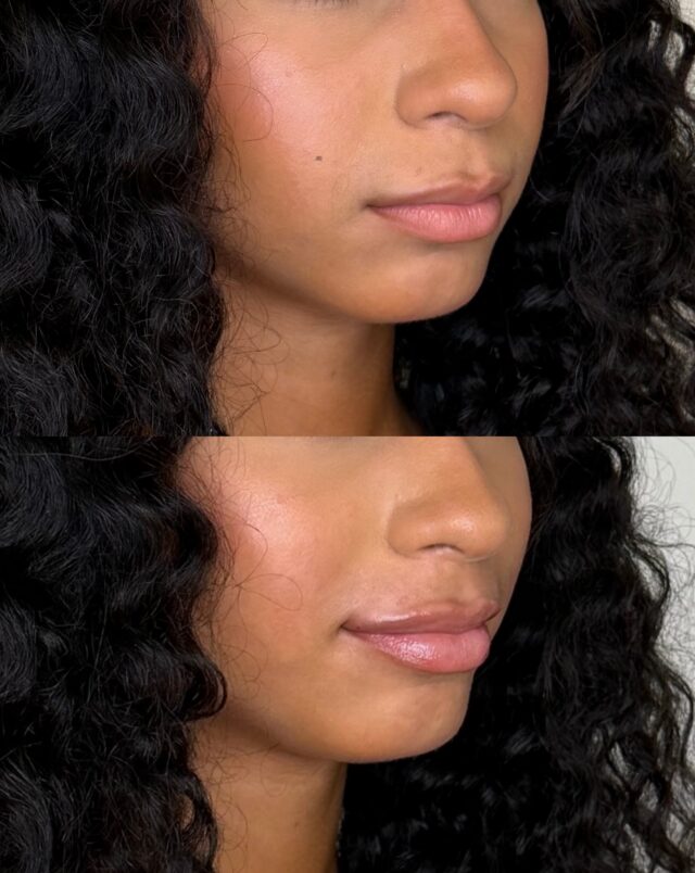 Adding lip filler can enhance shape, restore subtle volume and improve symmetry all while still looking like you. 

Every treatment at Ecobel is customized to your natural features and desired result for a soft, balanced finish.

Ecobel Med Spa & Plastic Surgery | Atlanta, GA