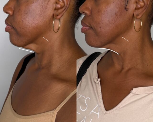 Endolift offers a little lift, without surgery. 

Endolift works from beneath the skin using a tiny fiber to stimulate collagen, tighten tissue, and help contour areas like the jawline, under-chin area, and neck. 

Minimal downtime. A natural, enhanced result.