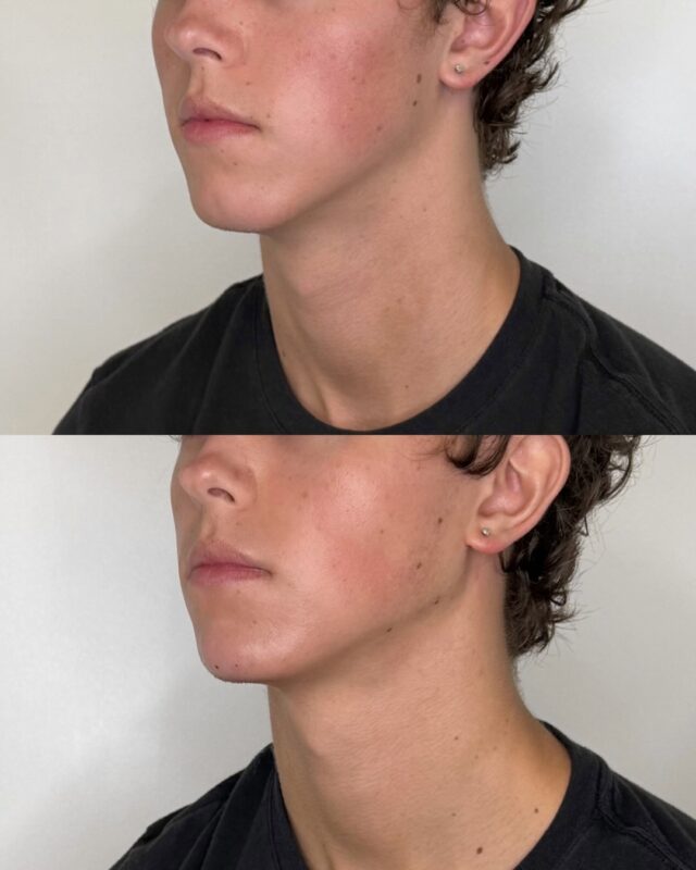 Enhancing what’s already there.

Subtle changes to the jawline bring the whole profile into balance, without anyone being able to say what’s different.

Consultations available. Link in bio to book. 

#malejawline #atlantamedspa #atlantamalebotox #atlantamalemodel #atlantabotox