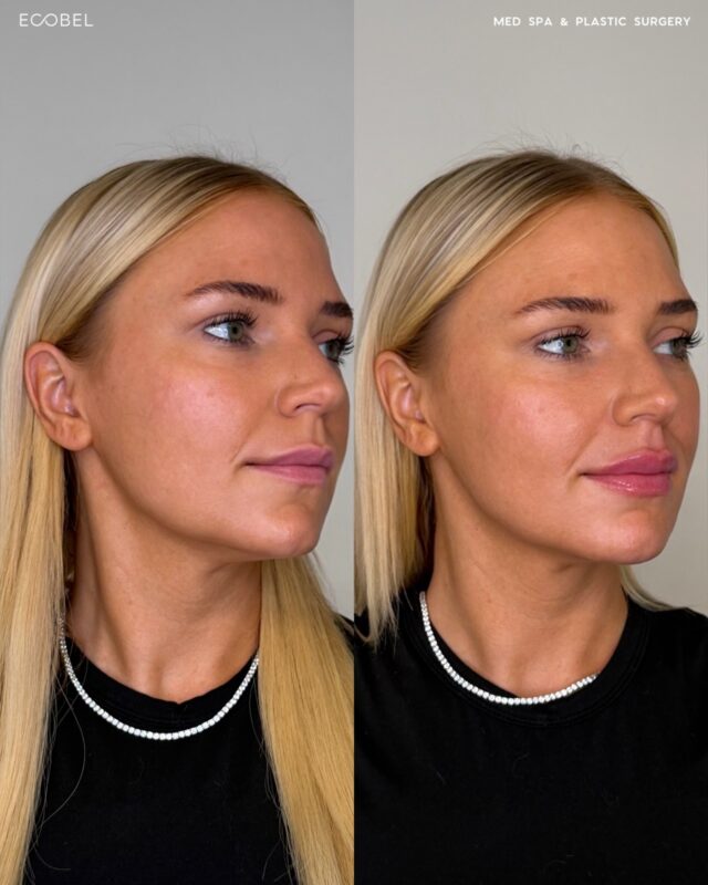 Filler can look like a subtle refresh, kind nobody can quite put their finger on. Same smile, same expressions, same you, just softer, balanced, and a touch more defined.

We specialize in a subtle lip technique that still enhances the features you love.

Ecobel Med Spa & Plastic Surgery | Atlanta, GA
404-960-0812