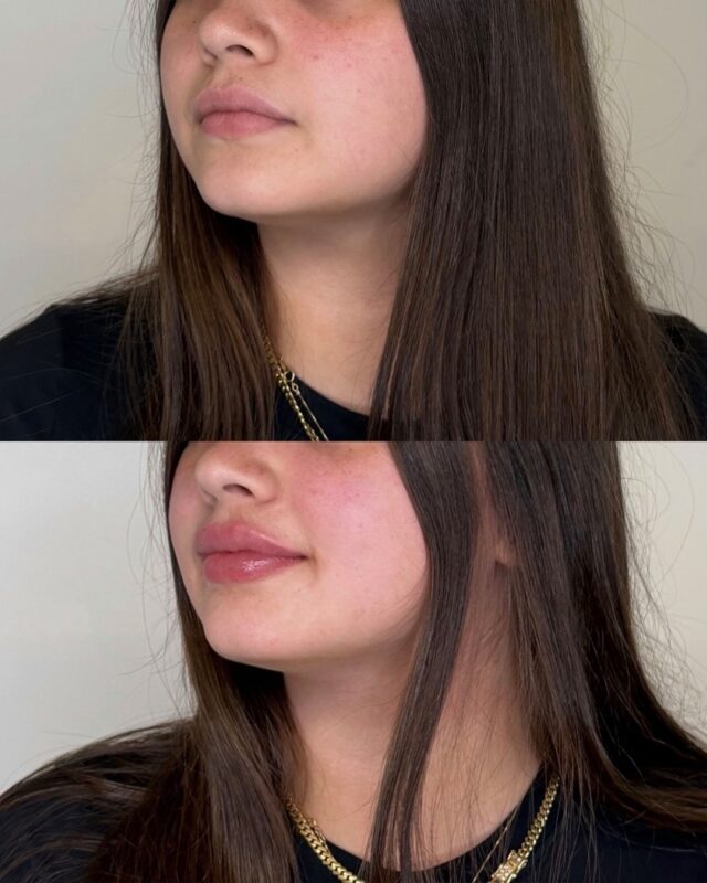 Our philosophy at Ecobel is about enhancing what you already have. We start each treatment with assessing your natural shape, symmetry and proportion. We build gradually.

This allows our clients to see a soft, refined result that settles over time. A treatment plan that is about creating a path that fits with your goals.