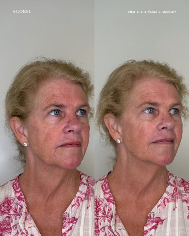 A subtle lift, with cheek filler. 

Restoring volume to the cheeks can help enhance facial contours, create the appearance of a gentle lift, and bring balance back to the face. The goal is never to change how you look, but to enhance what’s already there. 

Refreshed, not overdone.
