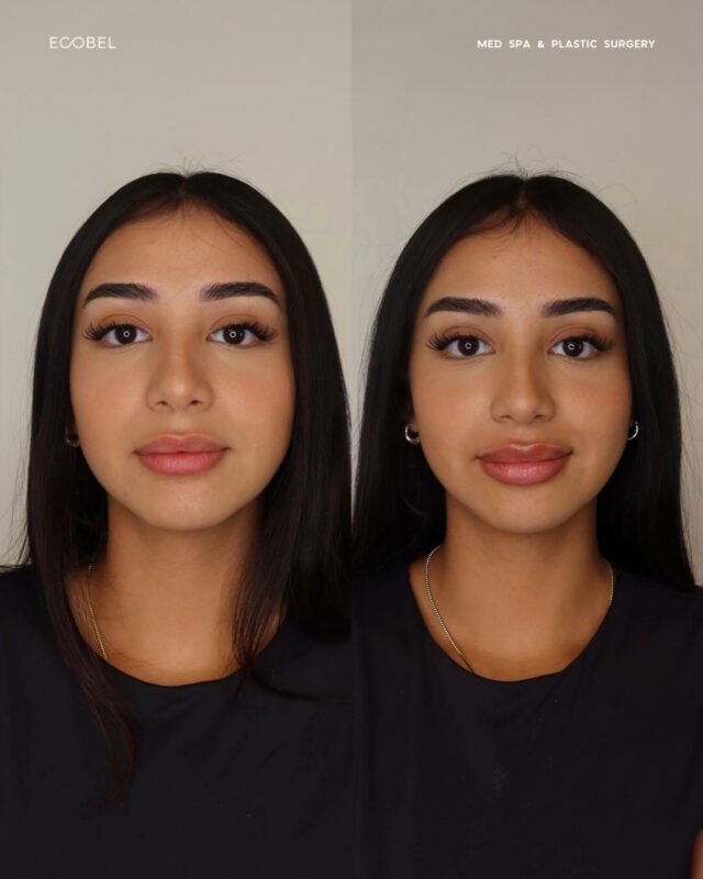 Subtle enhancements shouldn’t mean a different you. At Ecobel, we specialize in natural, undetectable results that refine, balance, and highlight your unique features.

Because the best results still look like you, just refined.

#atlantalipfillers #atlantabotox #atlantainjector #atlantainjectables #atlanta